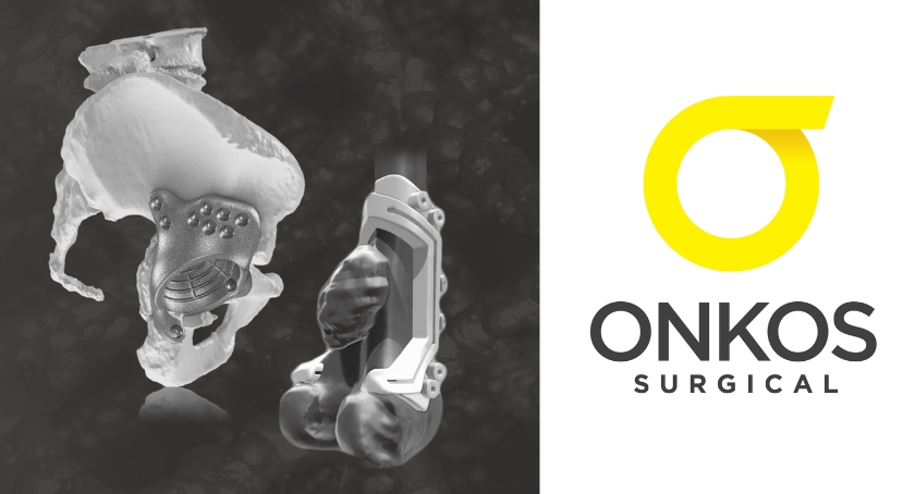 Onkos Surgical Marks 1,000th Personalized My3D Pelvic Implant Case